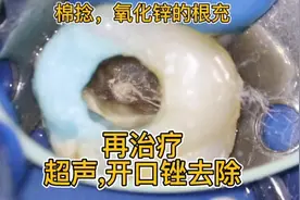 根管再治疗各种各样，这一例，根管内充填物为氧化锌棉捻视频封面