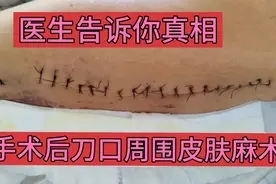 为什么手术后刀口周围皮肤麻木？如何预防？视频封面