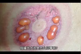 拔罐后出现水泡是怎么回事事呢？视频封面