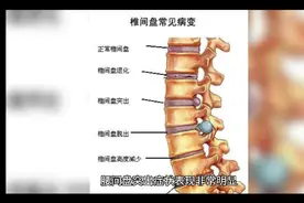 腰间盘突出有哪些症状视频封面
