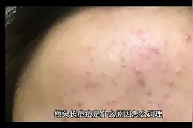 额头长痘痘怎么调理视频封面
