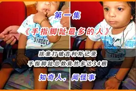 男孩手指脚趾，总数多达34根，打破吉利斯纪录，你知道是谁吗？视频封面