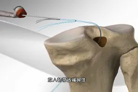 罗纳尔多经历的手术，后交叉韧带断裂修复手术，3D演示。。