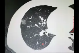 两个肺结节病例，都有一个共同点，最后CT诊断为恶性，医生分享视频封面