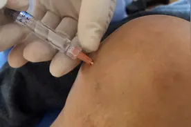 膝关节炎，臭氧穿刺针刀松解粘连，缓解膝关节半月板损伤撕裂症状视频封面