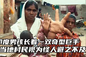 印度男孩天生巨型怪手，被村民视为怪胎，避之不及上学交友困难视频封面