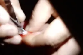 妹妹脚长了一个鸡眼，已经用药一个多月都没好，决定用针挑