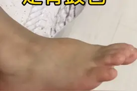 看看你家宝宝足背有没有鼓包，如果是这种情况就不要担心了视频封面