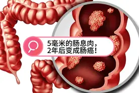 5毫米的肠息肉，2年后变成肠癌！医生坦言：3大教训值得反思！视频封面