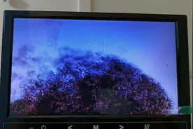 河南慢性前列腺炎病友，第三次理疗就把堵塞的小管排空了。视频封面