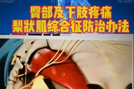 坐骨神经痛-梨状肌综合征防治视频封面