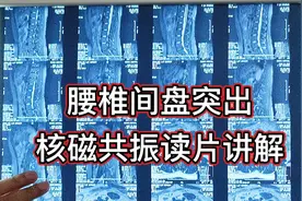 腰椎间盘突出如何快速诊断？影像学很重要！核磁共振图片讲解视频封面