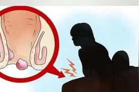 什么样的痔疮才要手术？视频封面