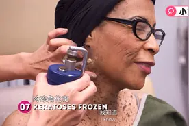 挤痘大师—几百个痣不要怕，李医生拿液态氮去除～视频封面