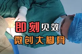 微创矫正大脚骨即刻见效，拇趾变直，凸起消失，后续不会复发