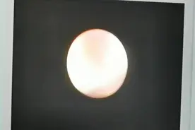看看慢性精囊炎里面是什么样的？视频封面