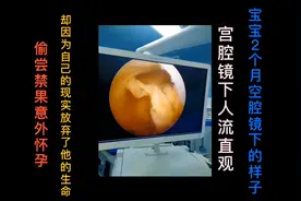 宫腔镜无痛人流手术视频封面