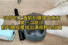 60岁上海前列腺增生病友初诊，前列腺按摩排出满视野前列腺结石。视频封面