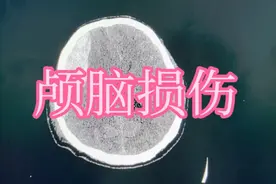 颅脑损伤CT表现:颅骨骨折、硬膜外血肿、脑挫裂伤…视频封面