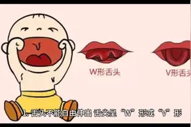 儿童舌系带的预防和治疗视频封面