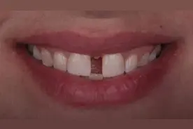 门牙缝隙大，漏财哟。视频封面