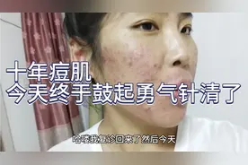 十年痘肌，今天终于鼓起勇气针清了，太疼了😞😞视频封面