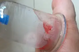 脚气太严重痒的要命，朝肉里扣，实在没招，拨罐半天一点血出来！视频封面