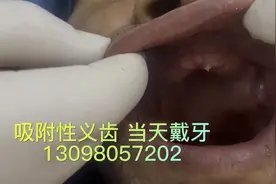 吸附性义齿 半口全口缺牙的首选。当天制作 当天戴牙视频封面