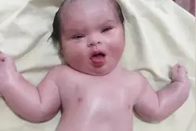 产房里刚出生的唐氏宝宝，长着同一张脸？网友：都有一张国际脸