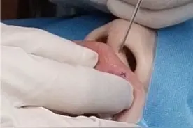 虎牙钉