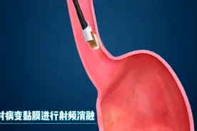 Barrett食管（芭蕾特食管）通过射频消融进行清除
