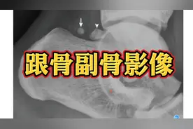 跟骨副骨典型影像病例分享，千万别误认为撕脱骨折！视频封面