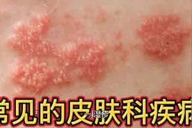 常见的皮肤科疾病视频封面
