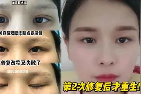 无知在美容院双眼皮割成宽深假，改窄又失败！第2次修复拯救了我视频封面