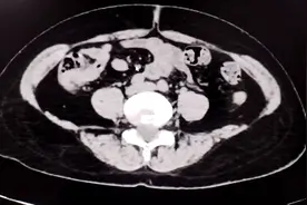 跑偏了的节育环！视频封面