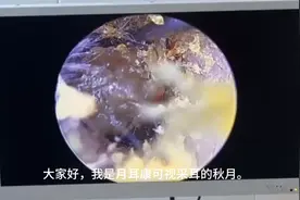 取耳结石的可视采耳视频