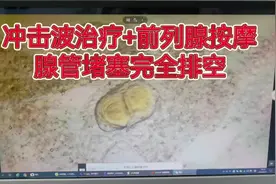 东莞前列腺炎，冲击波治疗疏通前叶腺管淤堵视频封面