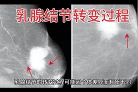 #乳腺结节转变过程视频封面