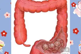 愈来愈多年轻人罹患大肠癌! 就医时70%已末期…最小竟只有14岁...