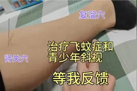 自学针灸，治疗飞蚊症第二针，用董氏奇穴特效穴组，等我反馈效果