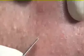 进群看更多挤痘视频视频封面