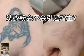 洗衣粉引起纹身过敏增生？怎么办？
