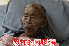 恐怖的麻风病绝迹几十年，死灰复燃，惊闻在广东清远发现两例患者视频封面