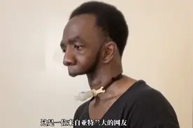 你见过天生没有下巴的人吗？视频封面