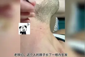 脖子上长了一根内生发，拔它，拔
