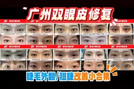 眼整形后竟睫毛外翻冲天/翘睫怎么办？广州潘贰双眼皮修复小合集