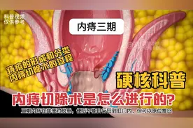 硬核科普：痔疮切除术的过程及痔疮的分类