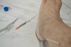 自己可以针灸吗？当然可以，自己做了一个进针器，开始针灸。😄😄视频封面