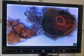 前列腺冲击波治疗，先打通出口，再打深处，效率更高。视频封面