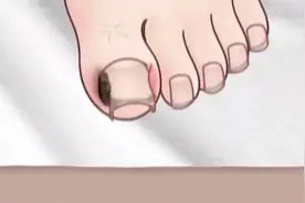 解压动画，三种甲沟炎清理动画视频封面